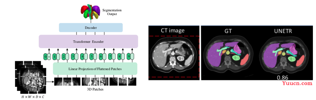 使用Tansformer分割三维腹部多器官--UNETR实战